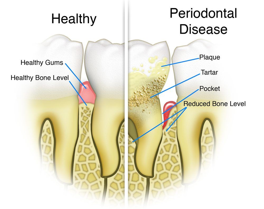 What is Periodontal Disease? » Premier Roanoke Dentist Randy J. Norbo DDS